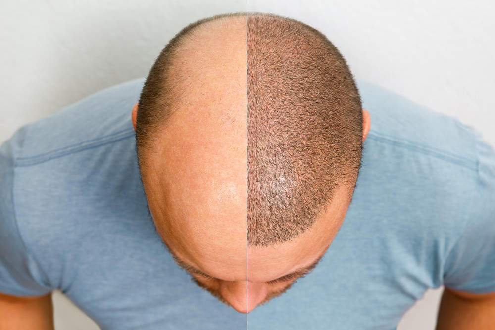 Scalp Pigmentation: Restoring Confidence Through Cosmetic Tattooing